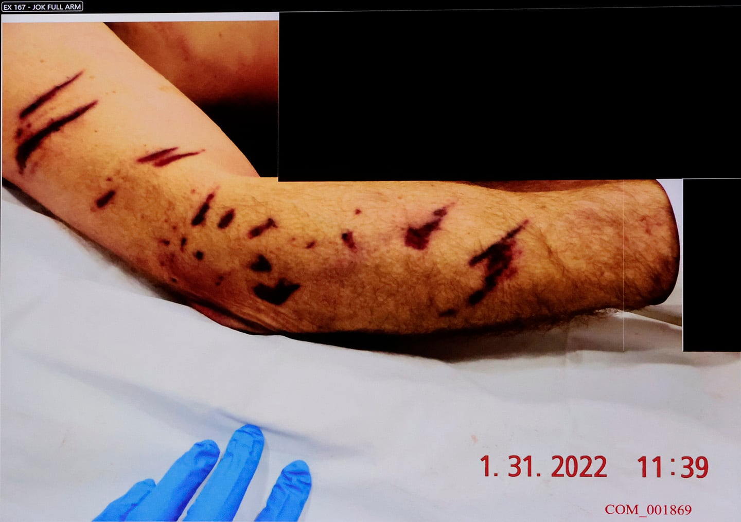 A photograph of John O’Keefe’s right arm is shown during the murder retrial of Karen Read in Norfolk Superior Court in Dedham on June 2.